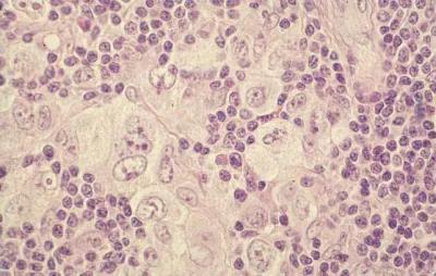 Immunobiology and Pathophysiology of Hodgkin Lymphomas